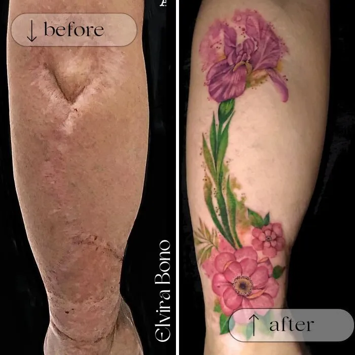 Tattoo In Surgical Scar After Traffic Accident
