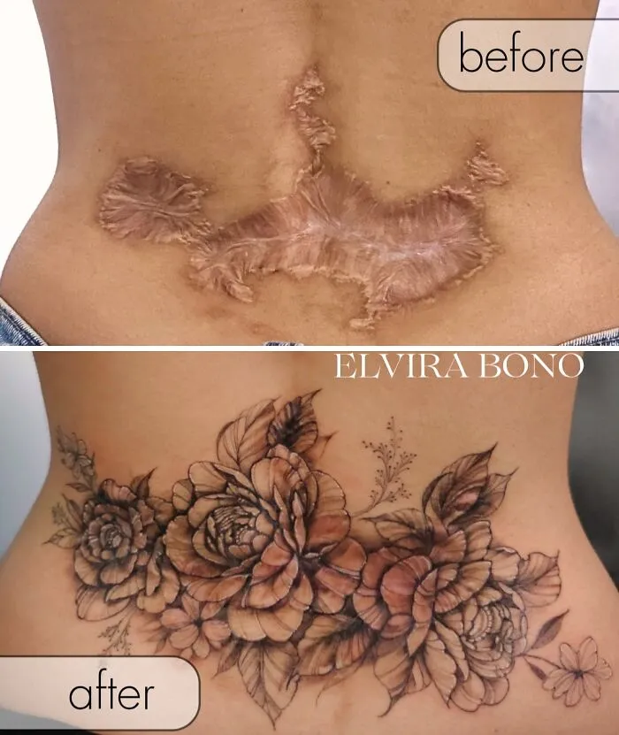 Tattoo In Scarring For Complications After Plastic Surgery