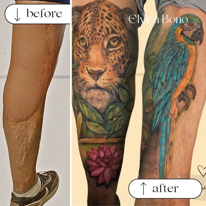 Tattoo On Extensive Burn Scar With Graft