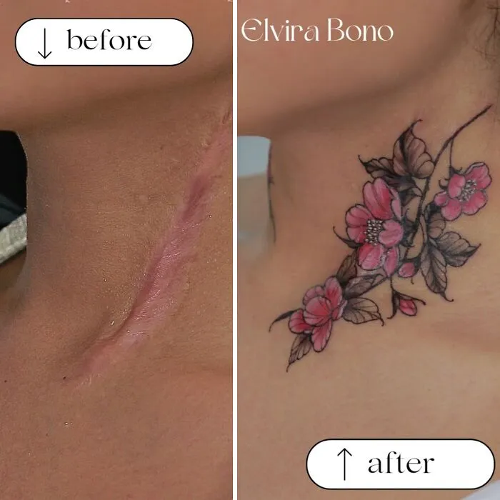 Tattooing On Surgical Scar