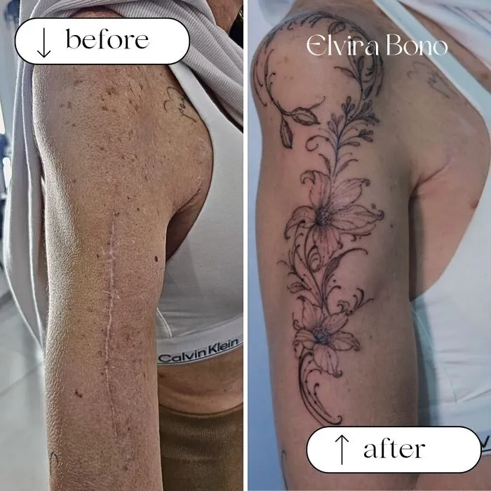 Tattoo In Surgical Scar After Traffic Accident