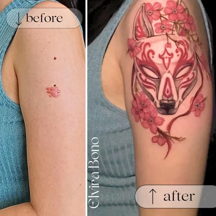 Tattoo In Scar By Surgical Removal Of Birthmark