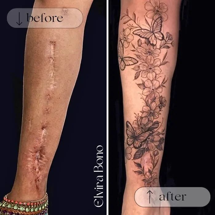 Tattoo In Surgical Scar After Traffic Accident