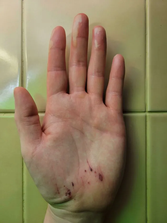 Burned My Fingers On A Hot Pan. The Next Day I Slipped On Ice And Cut Up My Palm