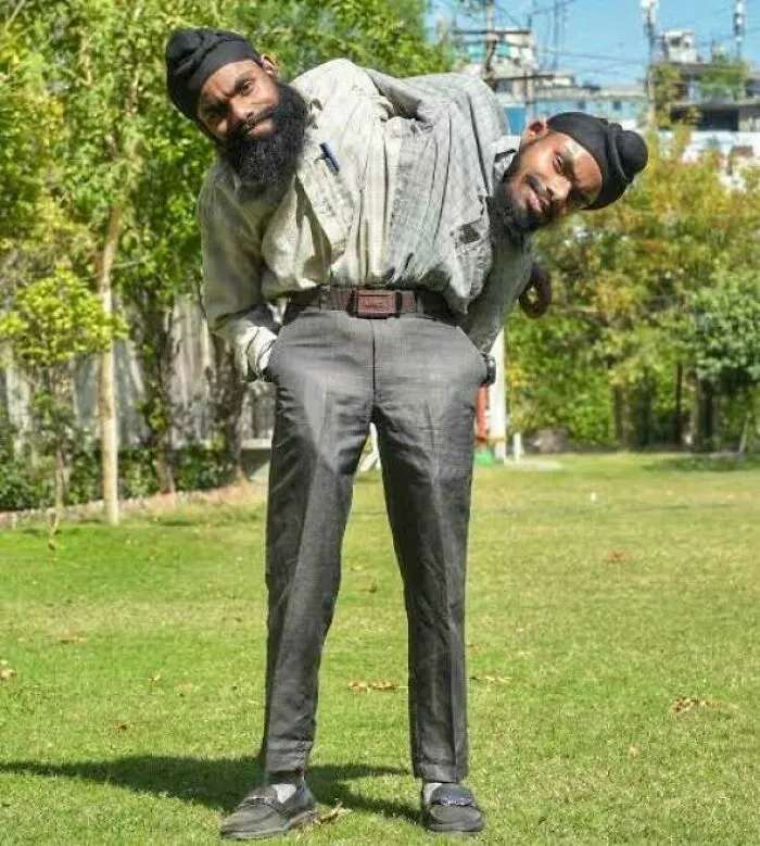 Sohna And Mohna Singh Are Conjoined Twins From Punjab, India. Born In 2003 With Two Hearts And Two Pairs Of Arms But Shared Legs, Liver, And Gallbladder. Abandoned At Birth, They Were Raised In A Shelter And Now Work As Electricians For The Punjab State Power Corporation