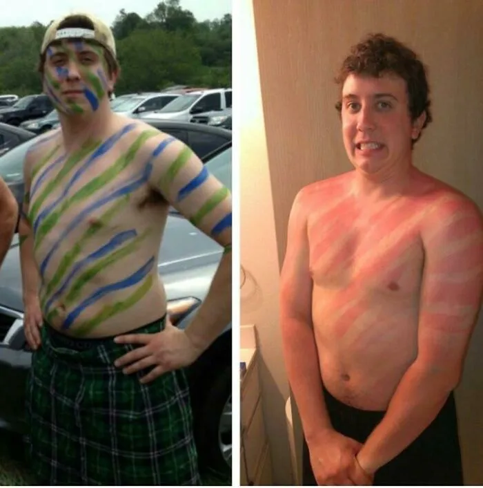 Someone Forgot His Sunscreen