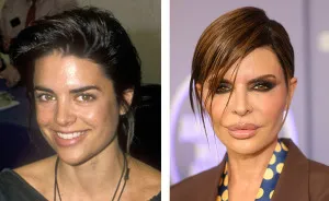 15 Fotos de antes y después de celebridades que se excedieron con la cirugía plástica