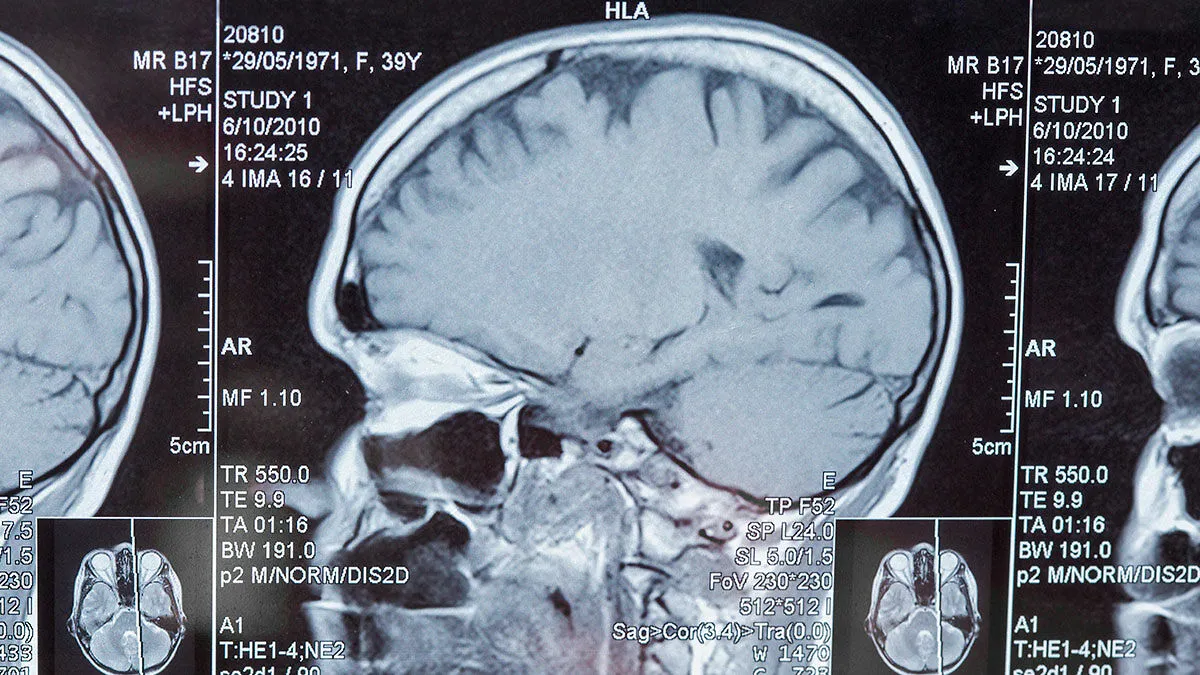 Man’s Suspected Brain Cancer Turns Into A Horror Story As Medical Team Uncovers Something Far Creepier