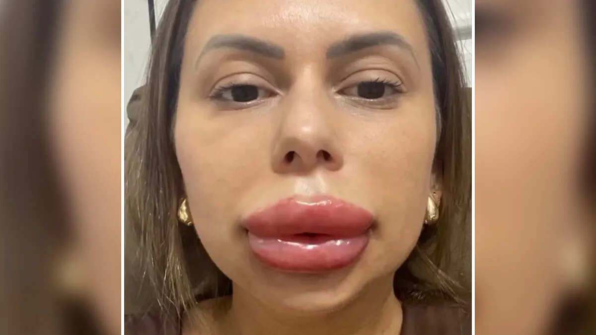 Woman’s Cosmetic Procedure Goes Viral As Her Face Changes Dramatically, Expert Weighs In And Explains The Risks