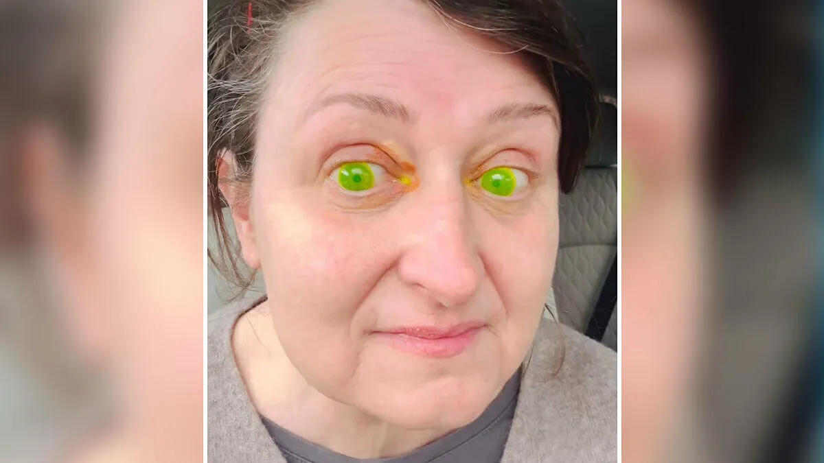 Woman Horrified After Her Pupils Turn Fluorescent Green During Routine Eye Exam, Experts Explain What Happened