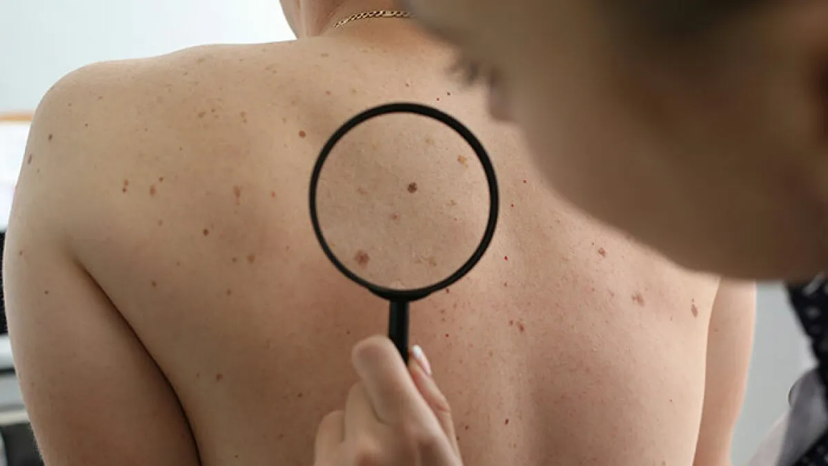 Dermatologist Reveals The Major Red Flag On Your Skin That Could Signal Heart Problems