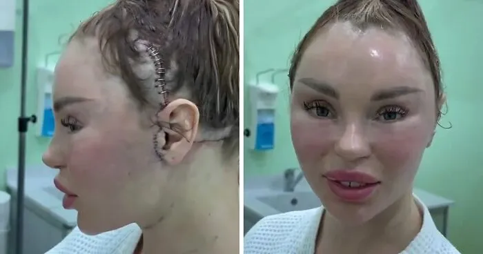 Woman’s Post-Plastic Surgery Photos Divide The Internet As She And Her Surgeon Celebrate The Results