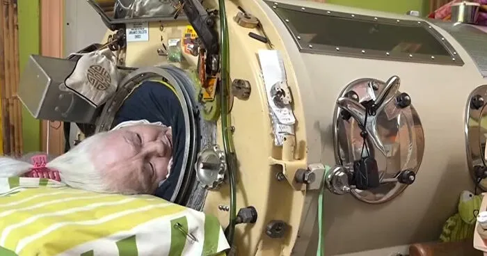 Woman, 78, Last Polio Survivor Living In Iron Lung, Passes Away After Machine Becomes Too Old To Repair
