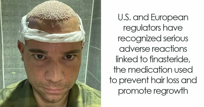 Men Spend Thousands On Hair Transplants Without Realizing The Bigger Decision Comes After