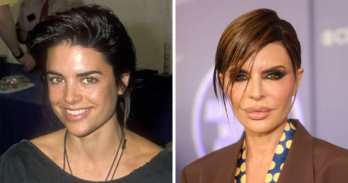 15 Fotos de antes y después de celebridades que se excedieron con la cirugía plástica
