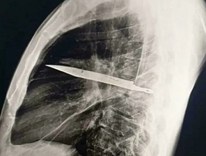 A 44-Year-Old Man Went To The Hospital After Pus Began Oozing From His Chest, Where Doctors Discovered A Knife That Had Been Embedded In His Body For Eight Years. According To The Report, He Showed No Signs Of Chest Pain, Breathing Problems, Coughing, Or Fever, And Was Otherwise In Good Health