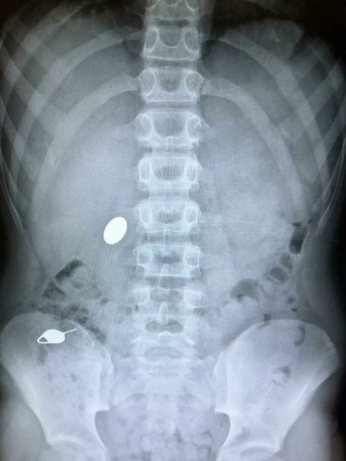 My Kid Swallowed A Penny While Showing His Little Brother How He Accidentally Swallowed A Sim Key The Day Before