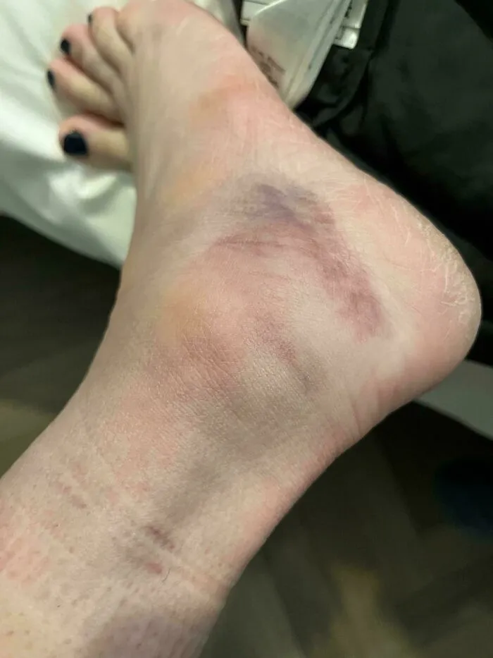 First Day Of Vacation In Italy I Fell On A Sidewalk In Milan And Sprained My Ankle