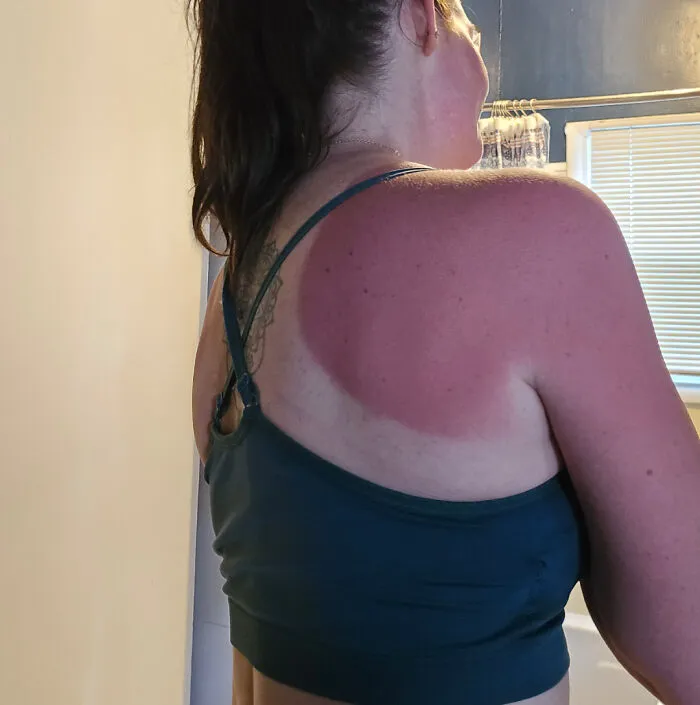 Was Helping My Husband Do Yard Work For An Elderly Lady And Forgot To Take Sunscreen!