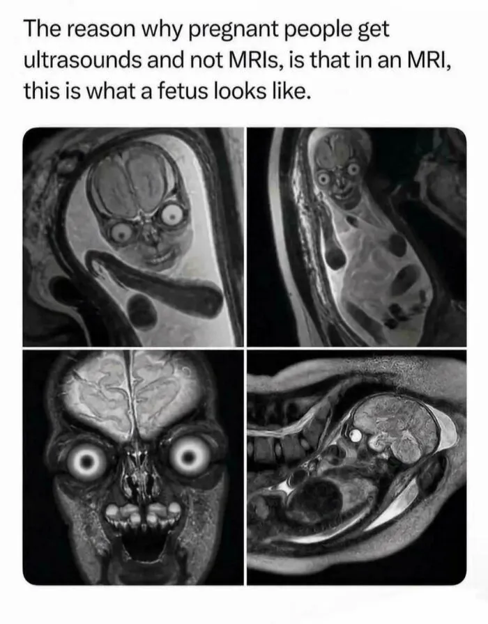Fetuses Look Like Aliens