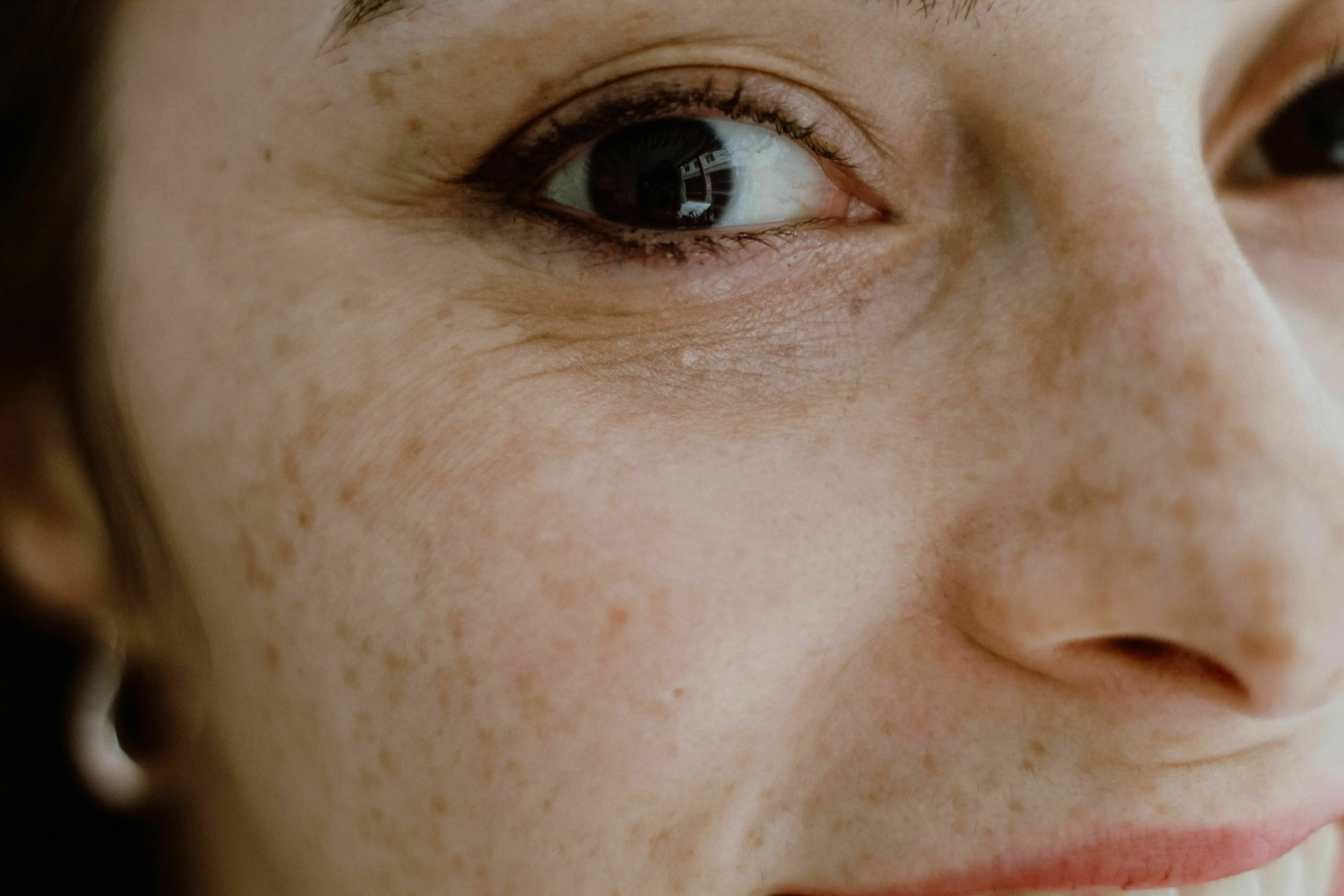 A close-up of a human eye and skin with freckles, highlighting the science of skin pigment.