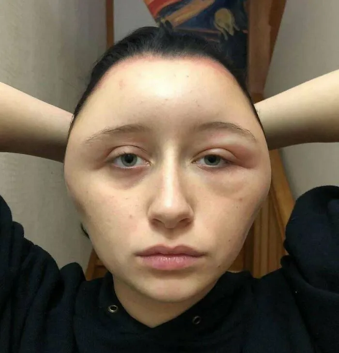 A Young Woman's Head After An Allergic Reaction To A Home Hair Dye Kit