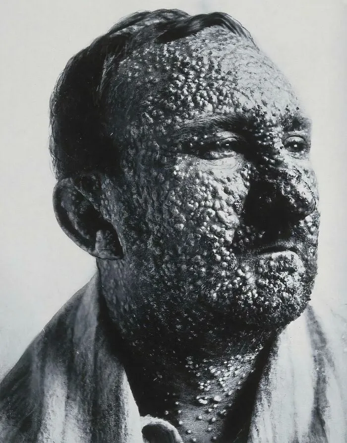 Man With Small Pox, C 1900