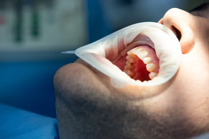 “They Told Me It Wouldn’t Be That Bad”: 62 People Share Extremely Painful Medical Procedures