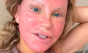 51-Year-Old Woman Goes Viral After She Breaks Down The Biggest Surprises Of Her Facelift