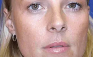 Identical Twins Show Dramatic Differences After One Uses Botox For 20 Years And The Other Doesn't