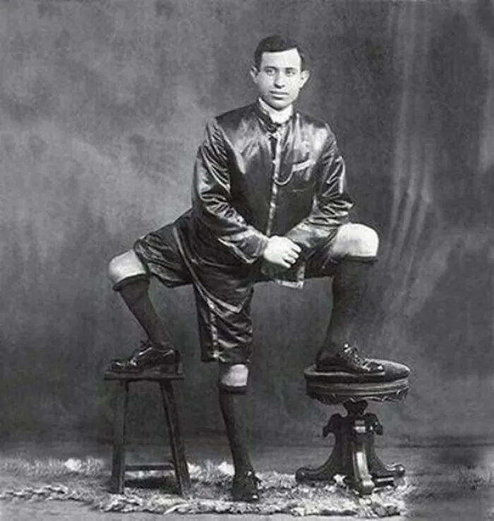 Frank Lentini, Owner Of 3 Legs, 16 Toes, And 2 Functioning Sets Of Genitals (1884-1966)