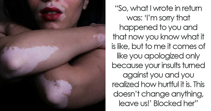  BF’s Mom Savagely Shames GF’s Skin For Years, Then Gets A Taste Of Her Own Hurtful Words