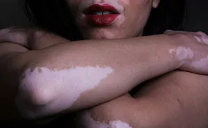  BF’s Mom Savagely Shames GF’s Skin For Years, Then Gets A Taste Of Her Own Hurtful Words
