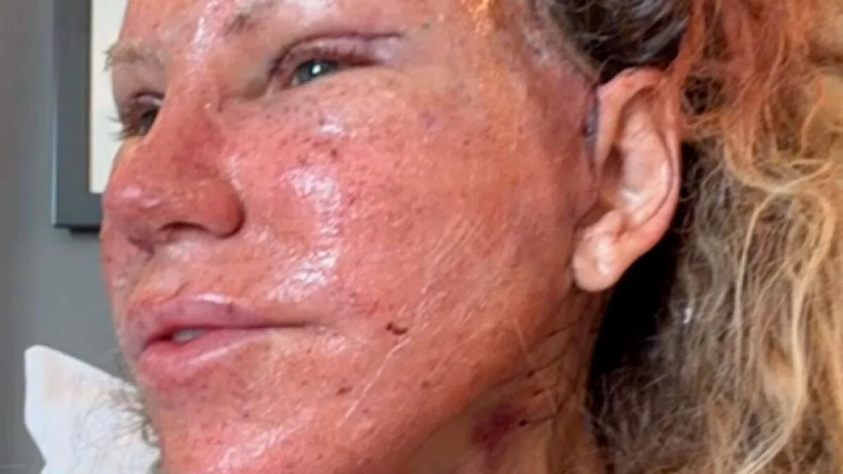 51-Year-Old Woman Goes Viral After She Breaks Down The Biggest Surprises Of Her Facelift