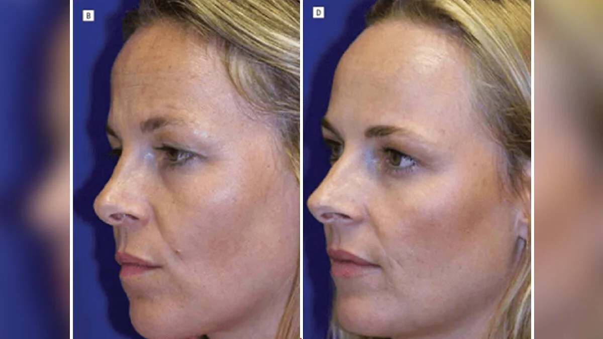 Identical Twins Show Dramatic Differences After One Uses Botox For 20 Years And The Other Doesn't