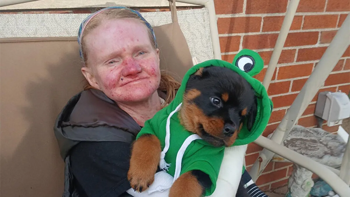 Woman With One Of The World’s Rarest Skin Conditions Details Extreme Measures To Protect Herself