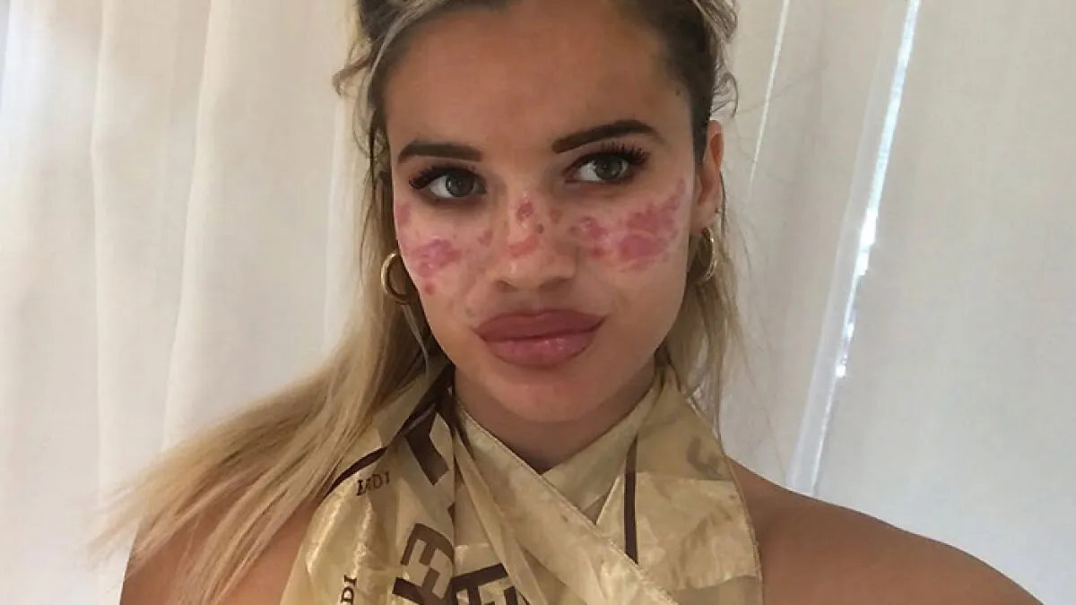 Reality Star Launches Fake Freckle Brand After Attempt At Tattooing Her Own Face For Viral Trend Left Her Scarred