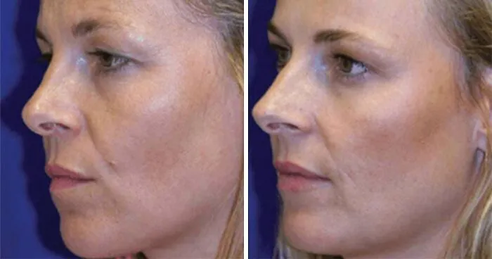 Identical Twins Show Dramatic Differences After One Uses Botox For 20 Years And The Other Doesn't