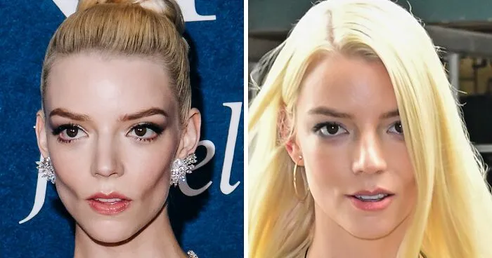 After Anya Taylor-Joy Seemingly Went Back On Her Buccal Fat Removal, Expert Weighs In On Reversal Procedure
