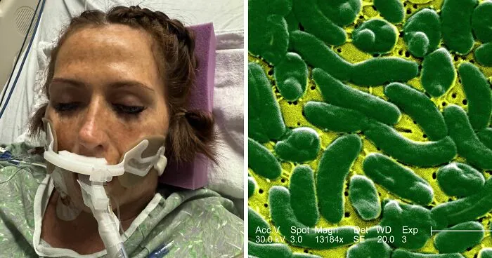 Woman Who Lost ‘A Lot Of My Leg’ To Flesh-Eating Bacteria Warns Women About Common Pre-Swim Habit