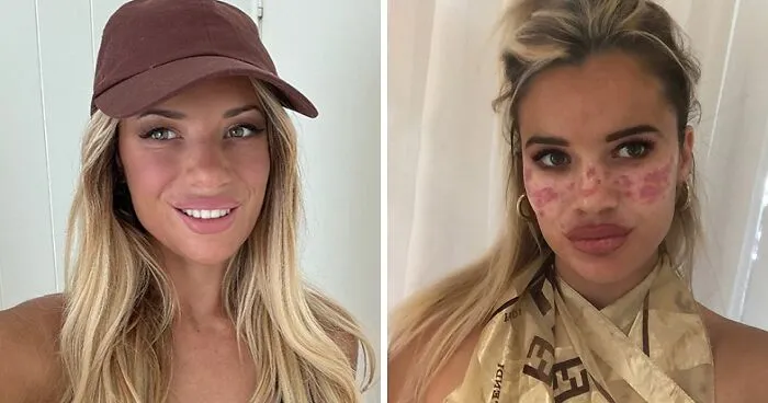 Reality Star Launches Fake Freckle Brand After Attempt At Tattooing Her Own Face For Viral Trend Left Her Scarred