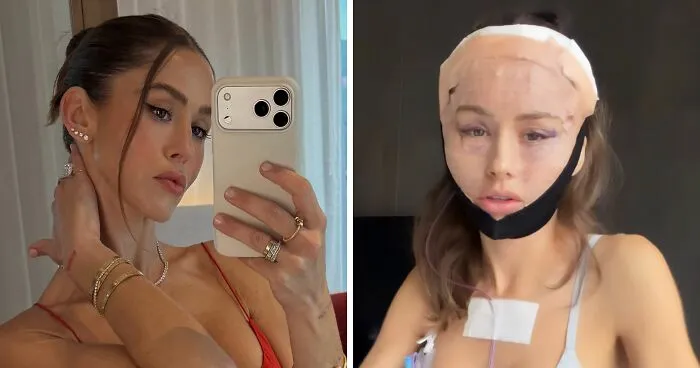 How Young Is Too Young To Get A Korean Facelift? Netizens Criticize Influencer's Decision After Recovery Posts