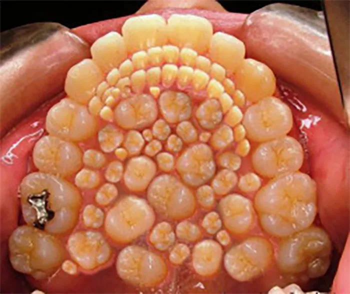 Hyperdontia