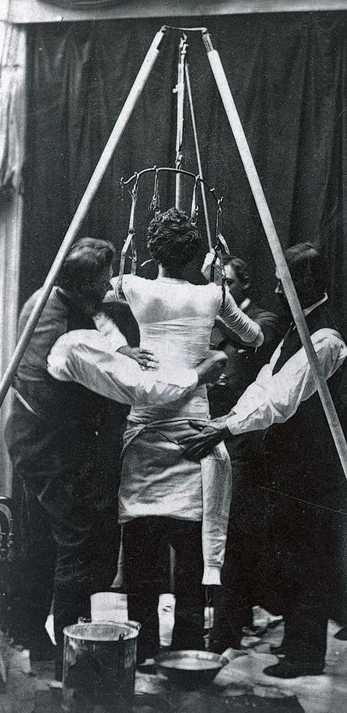Woman Undergoing Scoliosis Treatment, 1877