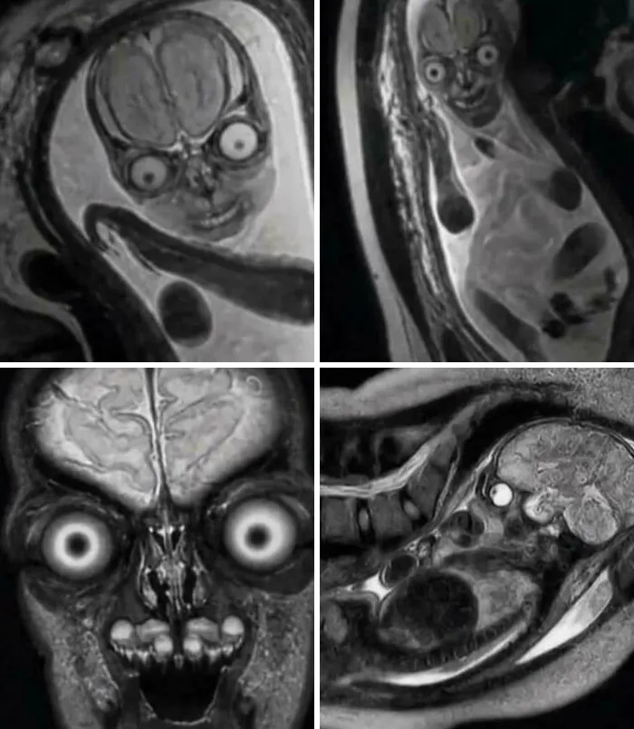 Fetuses Look Like Aliens
