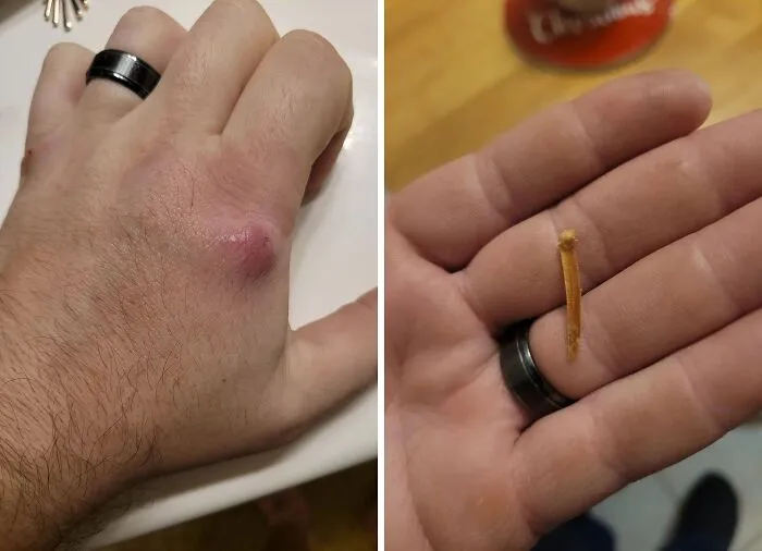 Thought I Had A Broken Knuckle For The Last 2.5 Years, Last Night This Splinter Popped Out