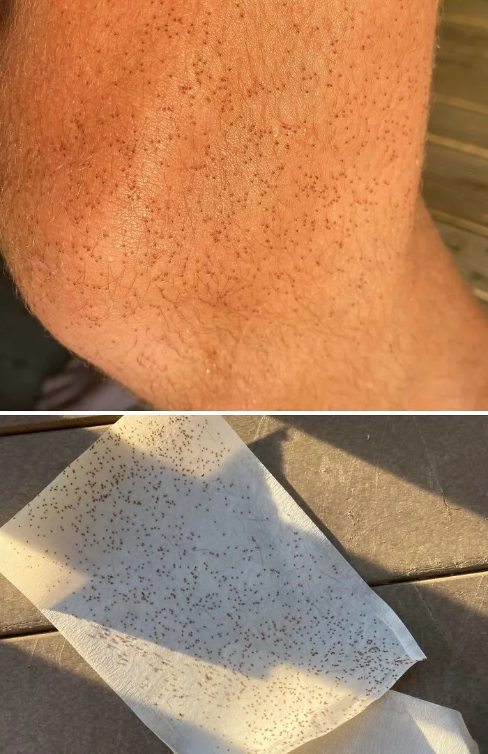 After Going On A Walk, I Was Horrified To Find That I Was Covered With Tiny Ticks. Stay Safe Out There