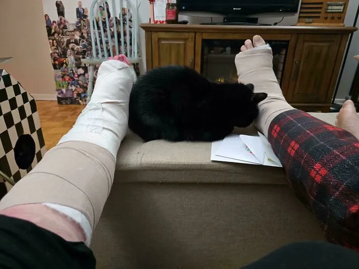 Husband And I Broke Same Leg, Same Bone, Within 30 Seconds Of Eachother Slipping On Ice