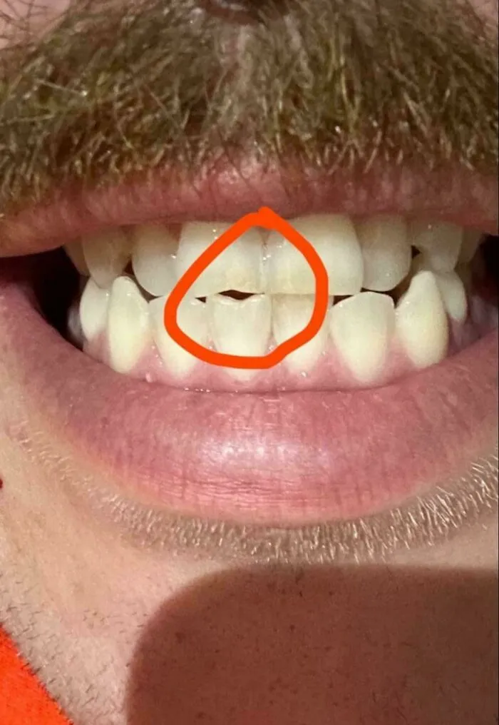 My Teeth Worn Down After Years Of Holding Sewing Needles In My Teeth