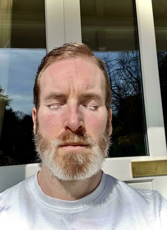 Vitiligo Turned My Eyelashes And Beard White